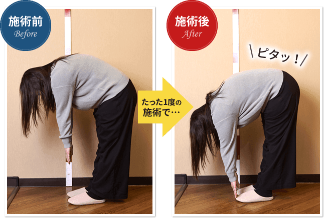 たった1度の施術で…